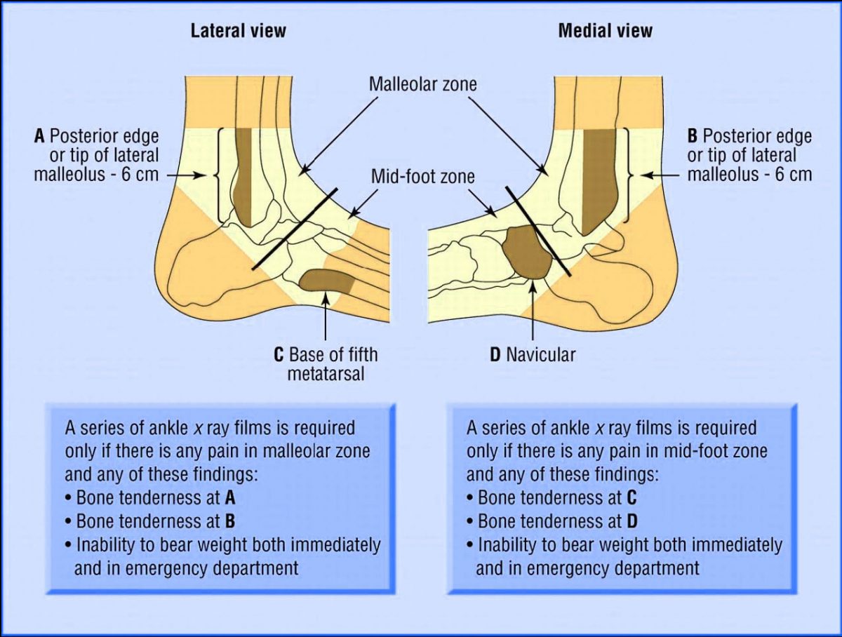 Sprained ankle explained edinburgh physiotherapist